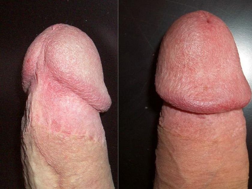 best of Penis circumcised