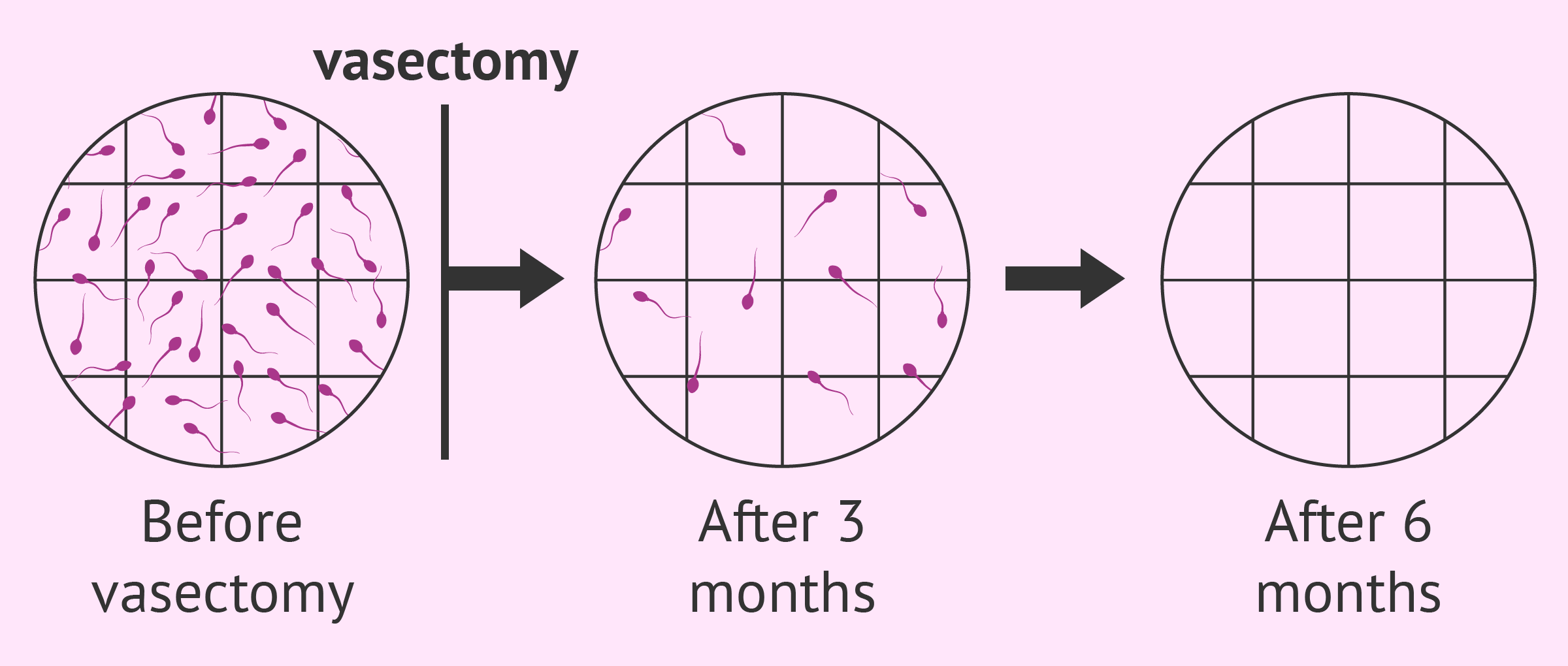 Saving male sperm before visectamy