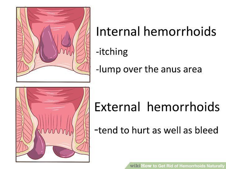 best of Outside the anus Hemorrhoid