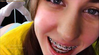 Detector recommend best of latina brace teen face