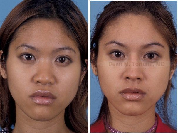 Ladygirl reccomend Asian rhinoplasty dr
