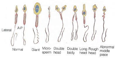 best of Morphology abnormal Remedy sperm