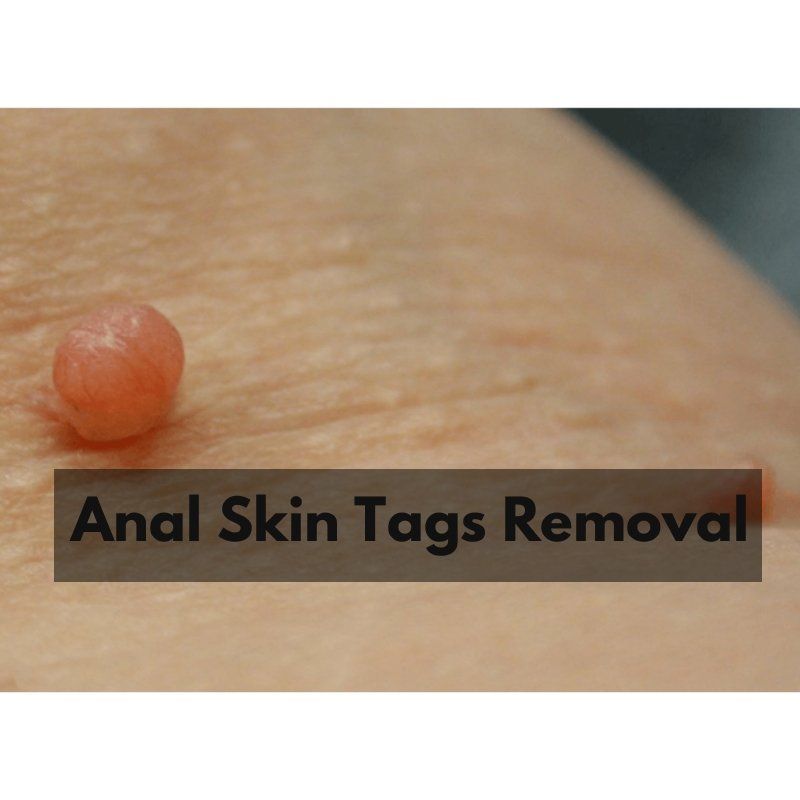 Monarch reccomend Anal skin tag removal