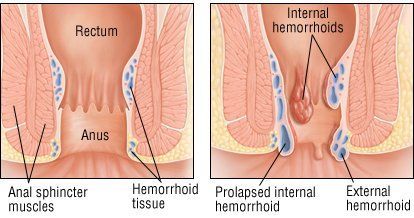 Guard reccomend Hemorrhoid outside the anus